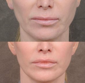 before-after photo platizmoplastika-podtazka-sei