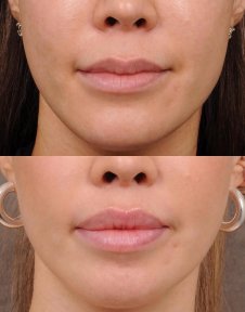 before-after photo platizmoplastika-podtazka-sei