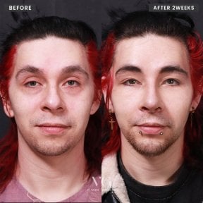 Resultados de rinoplastia antes y después en VG Plastic Surgery, remodelación nasal tras 2 semanas