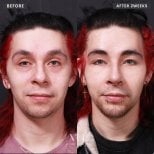 Resultados de rinoplastia antes y después en VG Plastic Surgery, remodelación nasal tras 2 semanas