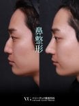 Resultados de rinoplastia antes y después en VG Plastic Surgery, perfil nasal mejorado en hombres