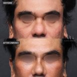 Lower eyelid blepharoplasty before and after results at VG Plastic Surgery, 2 weeks post-op