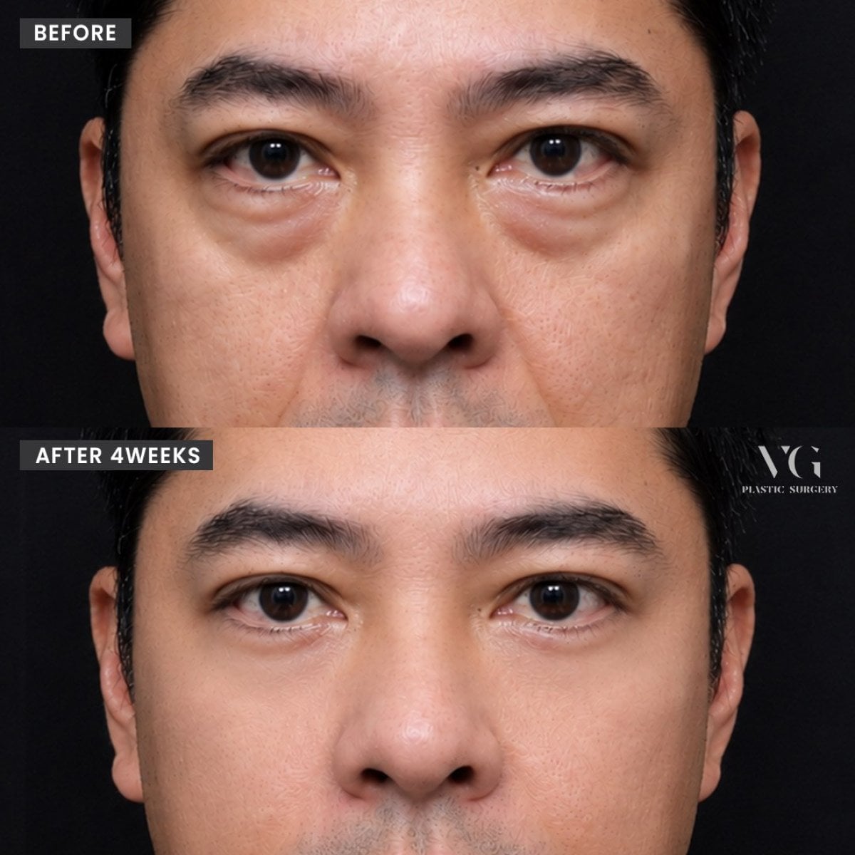 Resultados de blefaroplastia de párpado inferior antes y después en VG Plastic Surgery, menos bolsas