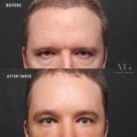 Résultats blépharoplastie des paupières inférieures avant/après chez VG Plastic Surgery, 1 semaine