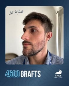 Результат пересадки бороди через 1 місяць, 4600 графтів у Smile Hair Clinic