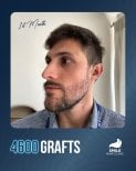 Результат пересадки бороди через 1 місяць, 4600 графтів у Smile Hair Clinic