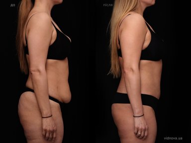 Before and after tummy tuck results at Vidnova Clinic – improved abdominal contour