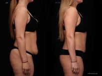 Before and after tummy tuck results at Vidnova Clinic – improved abdominal contour