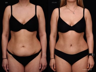 Before and after tummy tuck results at Vidnova Clinic – visible abdominal contour improvement