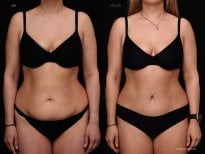 Before and after tummy tuck results at Vidnova Clinic – visible abdominal contour improvement