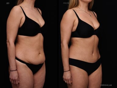Before and after tummy tuck results at Vidnova Clinic – visible abdominal contour improvement
