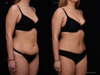 Before and after tummy tuck results at Vidnova Clinic – visible abdominal contour improvement