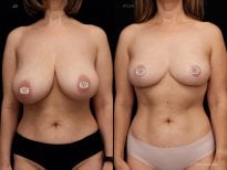 Before and after breast reduction results at Vidnova Clinic – improved breast shape and size