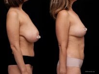 Before and after breast reduction results at Vidnova Clinic – improved breast contour