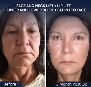 before-after photo deep-plane-facelift