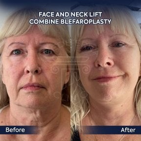 before-after photo deep-plane-facelift