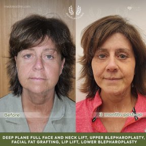 before-after photo deep-plane-facelift