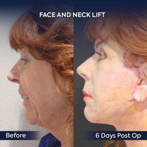 before-after photo deep-plane-facelift