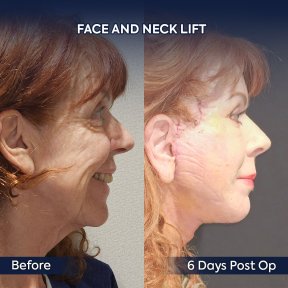 before-after photo deep-plane-facelift