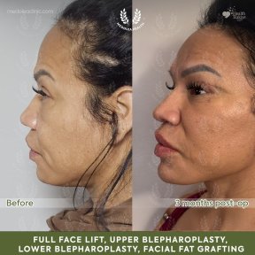 before-after photo deep-plane-facelift
