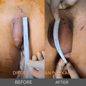 before-after photo penis-enlargement