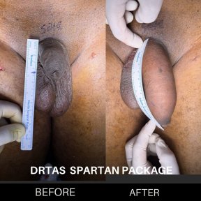 before-after photo penis-enlargement
