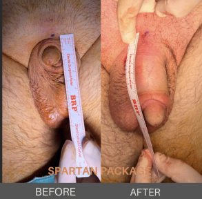 before-after photo penis-enlargement