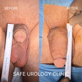 before-after photo penis-enlargement