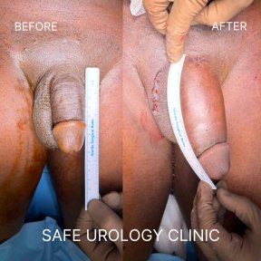 before-after photo penis-enlargement
