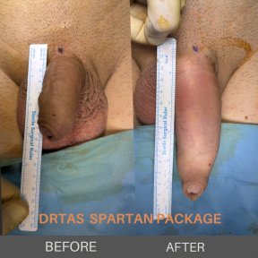 before-after photo penis-enlargement