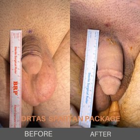 before-after photo penis-enlargement