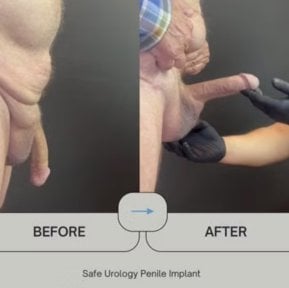 before-after photo penile-implant-surgery