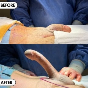 before-after photo penile-implant-surgery