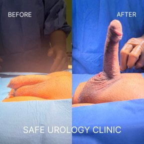 before-after photo penile-implant-surgery