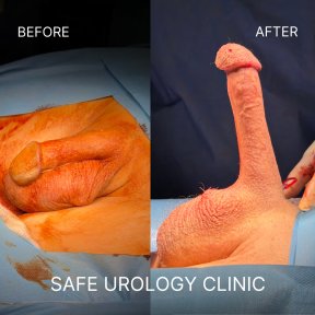 before-after photo penile-implant-surgery