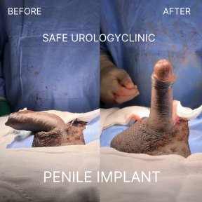 before-after photo penile-implant-surgery