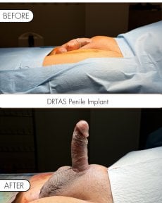 before-after photo penile-implant-surgery