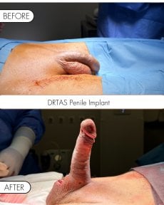 before-after photo penile-implant-surgery