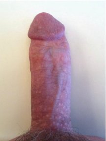 before-after photo penile-curvature-correction-surgical-treatment-for-peyronies-disease