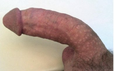 before-after photo penile-curvature-correction-surgical-treatment-for-peyronies-disease