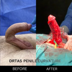 before-after photo penile-curvature-correction-surgical-treatment-for-peyronies-disease