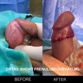 before-after photo penile-curvature-correction-surgical-treatment-for-peyronies-disease