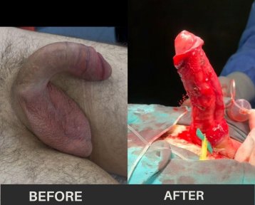 before-after photo penile-curvature-correction-surgical-treatment-for-peyronies-disease