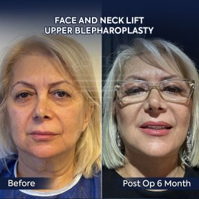 before-after photo deep-plane-facelift