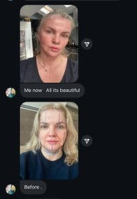 before-after photo deep-plane-facelift