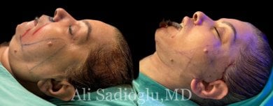 before-after photo deep-plane-facelift