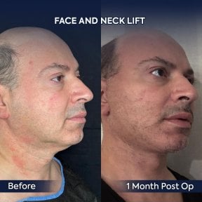 before-after photo deep-plane-facelift