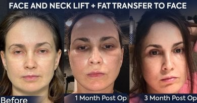 before-after photo deep-plane-facelift