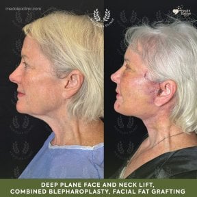 before-after photo deep-plane-facelift
