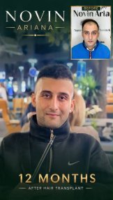 Before and after Sapphire FUE hair transplant result at NOVİN ARİANA, 12 months progress